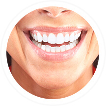 Facettes dentaires | Dent Smile