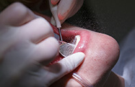 Cyst Treatments | Dent Smile