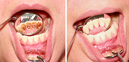 Détartrage dentaire | Dent Smile