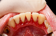 Gingival Recession | Dent Smile