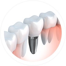 Zahnimplantate | Dent Smile