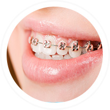 Orthodontie | Dent Smile