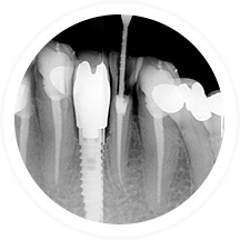 Root Canal Treatment | Dent Smile