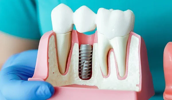 Dental Implant Prices