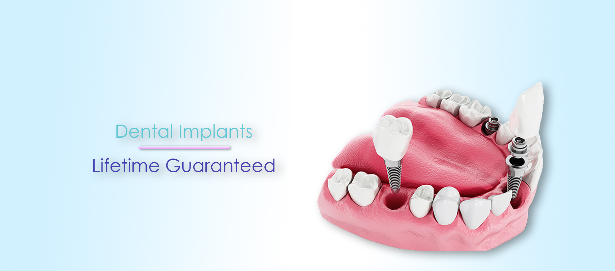 Implants dentaires durée de vie garantie