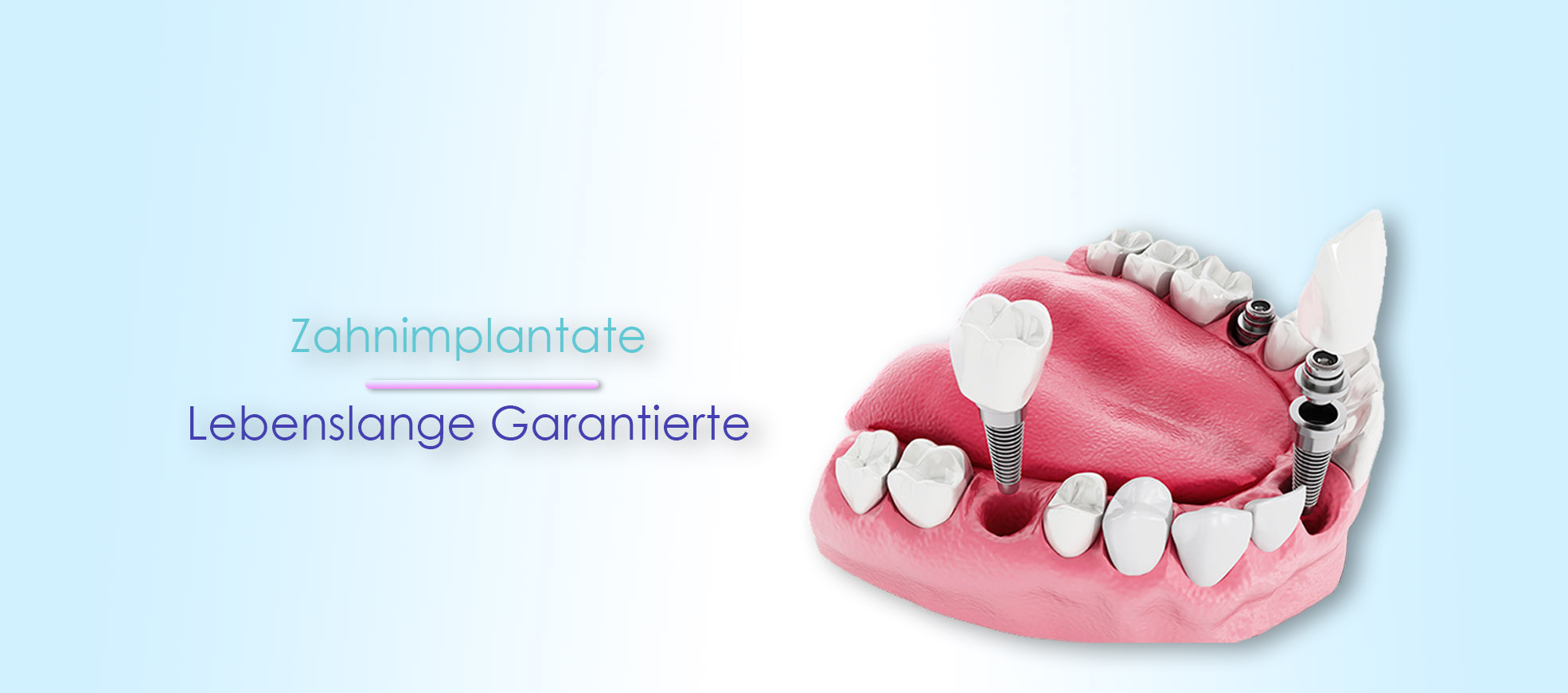 Lebenslange garantierte Zahnimplantate