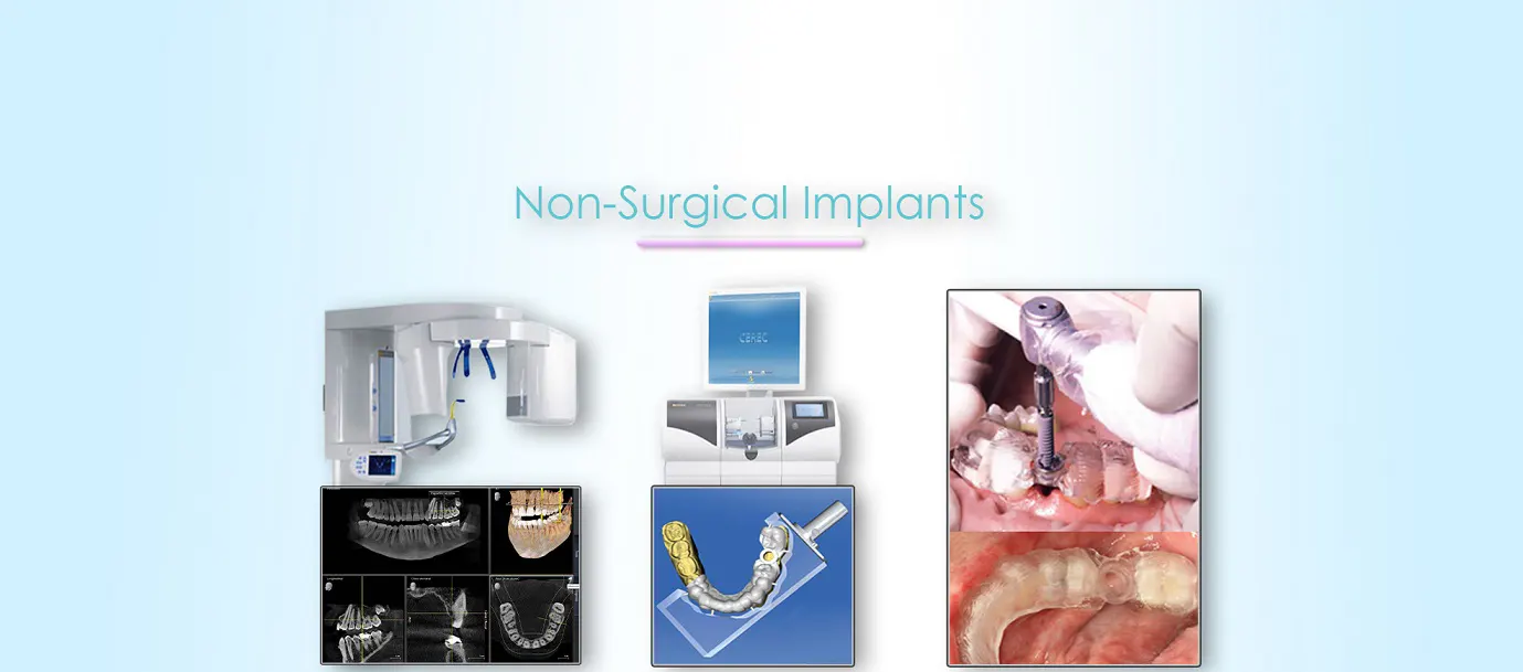 Non Surgical Implants