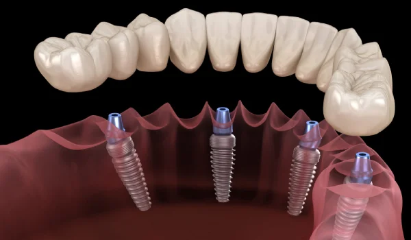 Turkey Dental Implants
